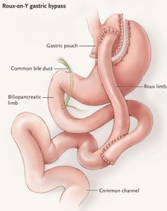 Diagram Roux-en-y Gastric Bypass